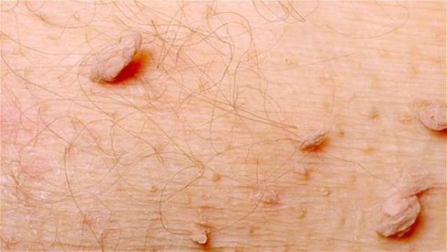 Descrierea tratamentului condilomului Papiloame și condiloame în locuri intime - Alopecie